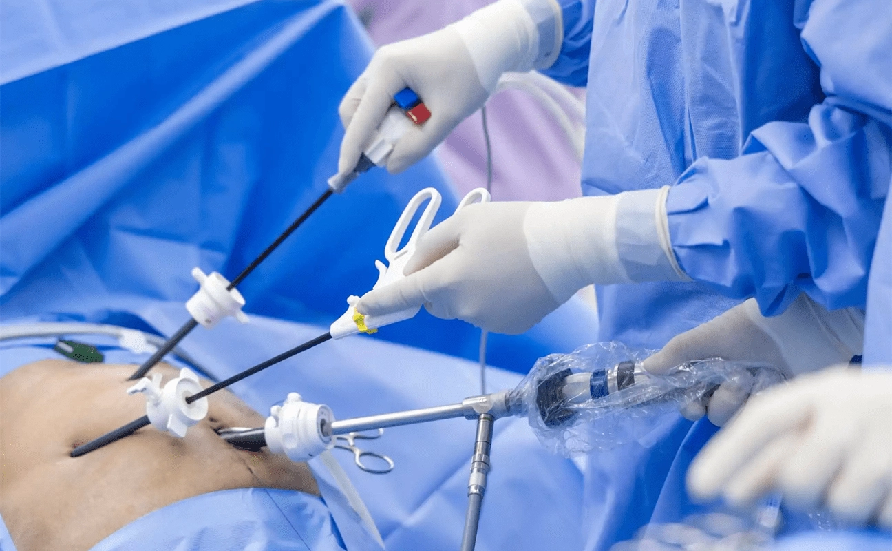 Laparoscopic Gynecological Surgeries