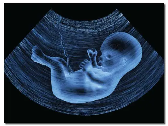 NT Scan (Nuchal Translucency)