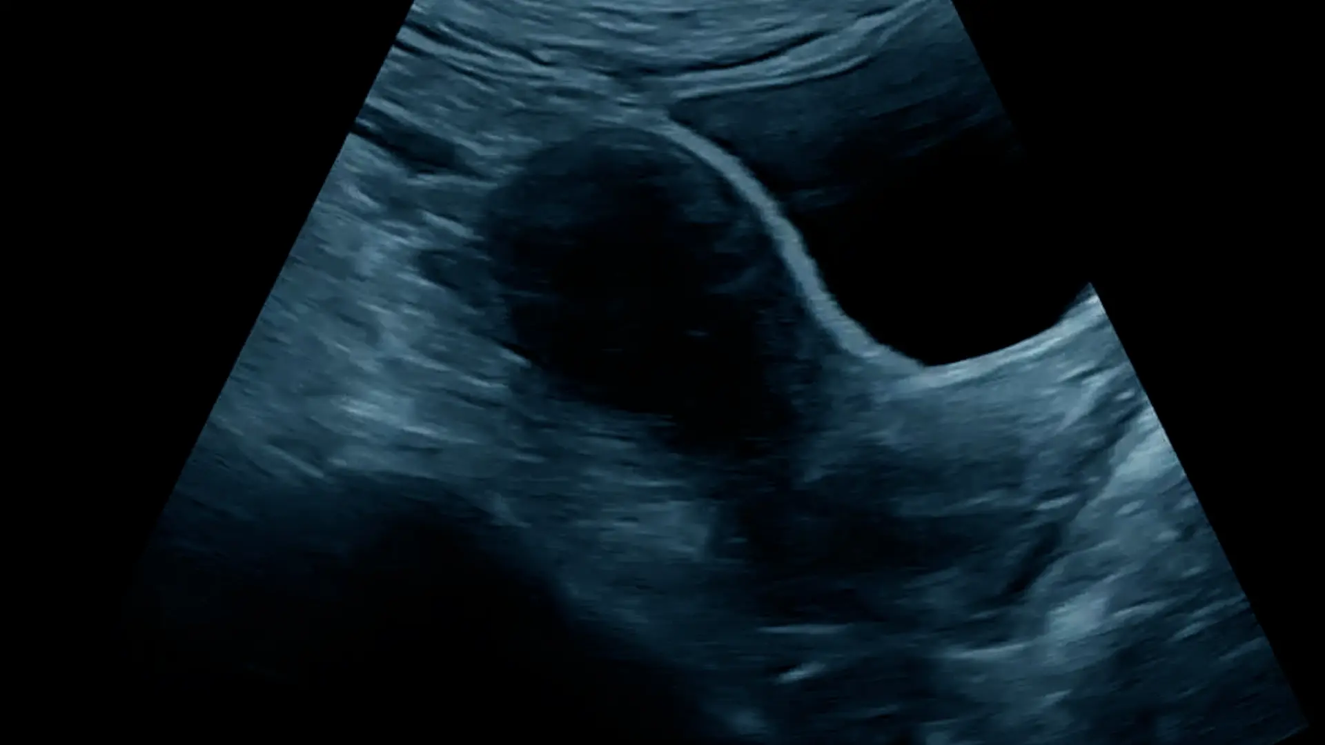 Pelvic Ultrasound Scan